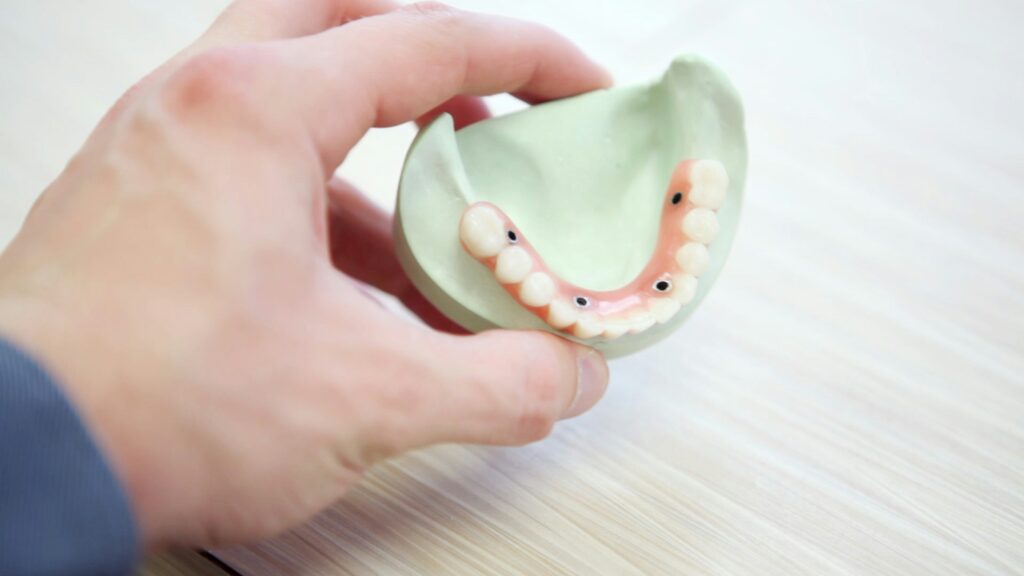 Dental Erosion