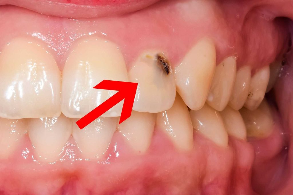 The Real Reason For Cavities Form